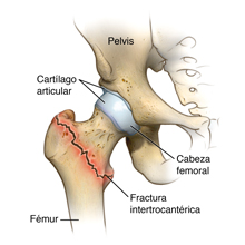 Fractura intertrocantérica de cadera